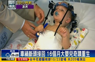 16个月宝宝意外断头颅后奇迹般活下来